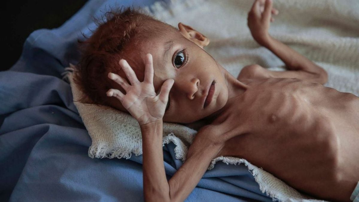 "قبل فوات الأوان".. إطلاق "نداء أممي" لإنقاذ 30 مليون طفل جائع