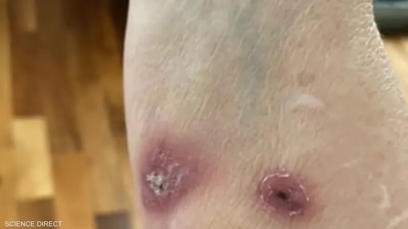 ينتقل عبر القطط.. ظهور مرض جلدي نادر في بريطانيا