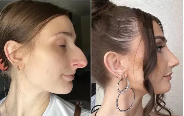 عملية تجميل الأنف تدفع امرأة لاتخاذ قرار الطلاق وبدء حياة جديدة (فيديو)