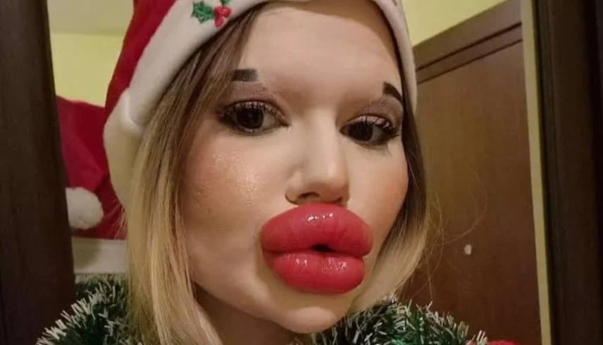 بسبب مظهرها.. صاحبة أكبر شفاه في العالم ممنوعة من العلاج!