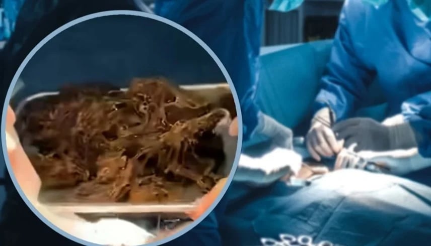 أطباء يستخرجون 2 كيلوغرام شعر من معدة فتاة!