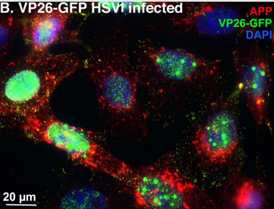 Herpesvirus Infection Linked to Accelerated Alzheimer’s Progression