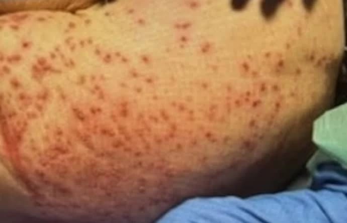 لدغات النمل الناري تُودي بحياة مسنّة في دار رعاية ساوث كارولاينا