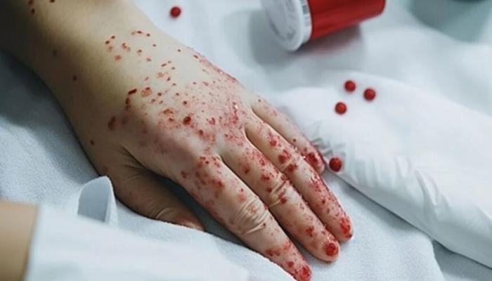E vita Trial: 54% Reduction in Mortality with Vitamin C for Patients with Blood Disorders