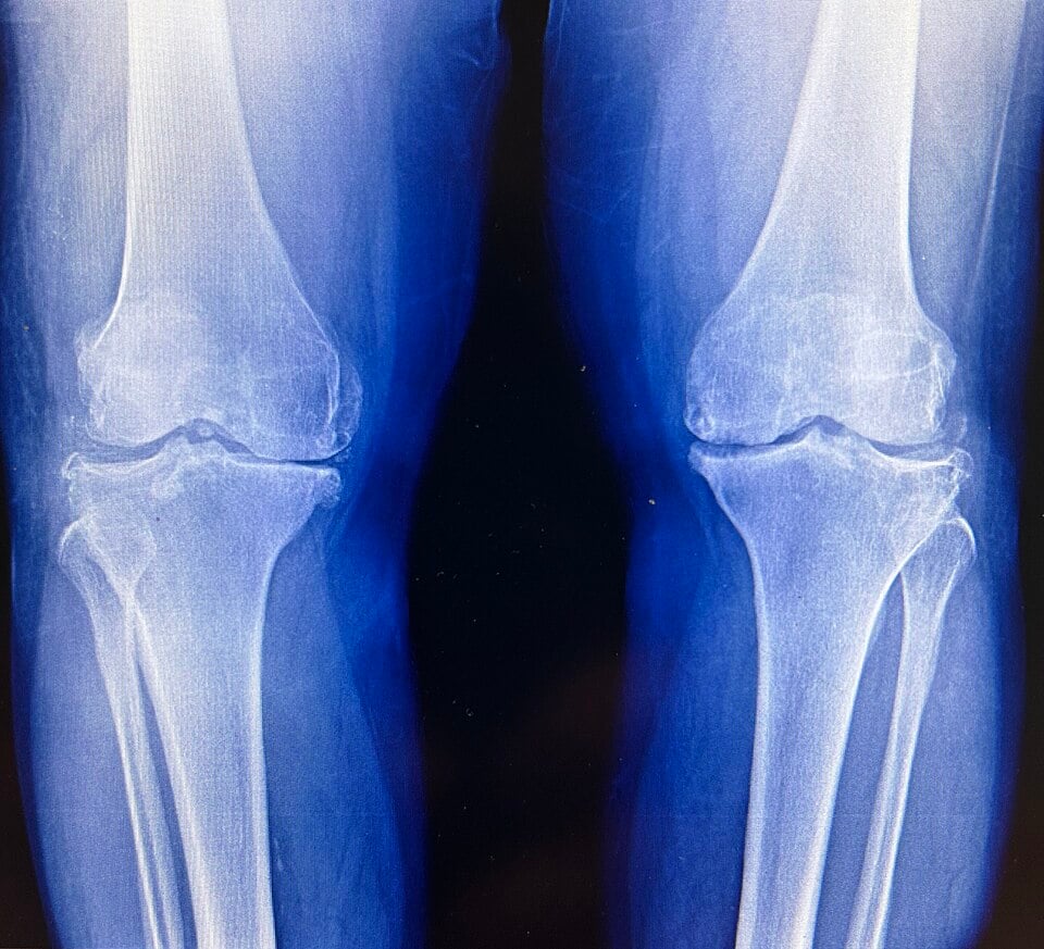 عادات بسيطة قد تقلل خطر الإصابة بهشاشة المفاصل في الركبة
