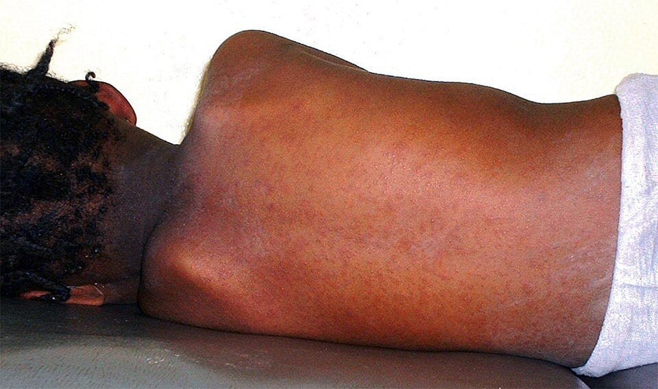 Pennsylvania Reports 792 Measles Cases Amid U.S. Total of 3,471