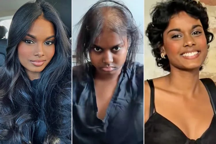 À 22 ans, elle redéfinit sa beauté après la perte de ses cheveux