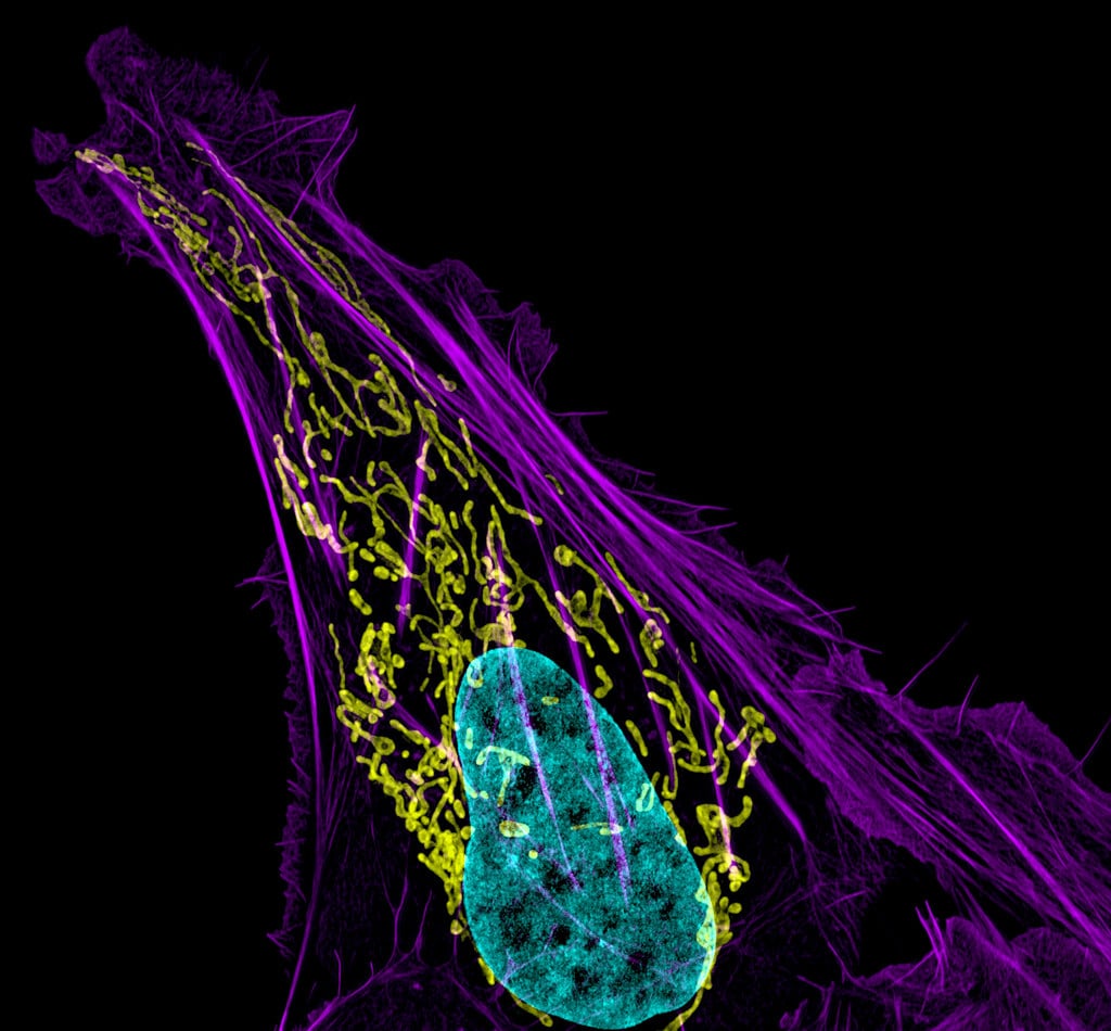 Bone cancer cell