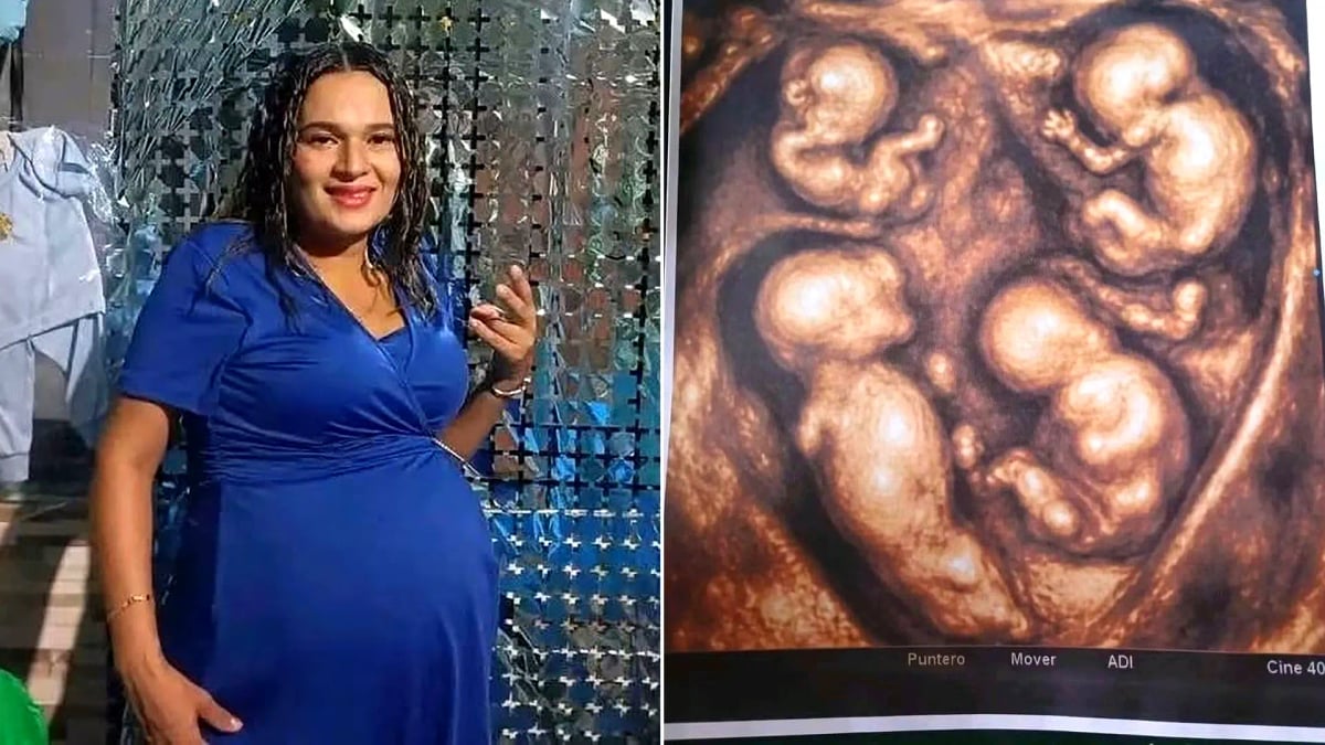 Rare 'one-in-15-million' monozygotic quadruplet case reported in Colombia.