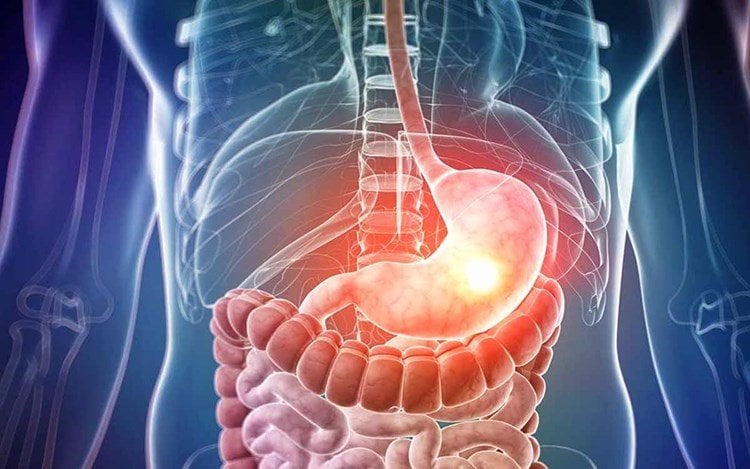 أعراض ارتجاع المريء.. هل يمكن التخلص منها نهائياً؟