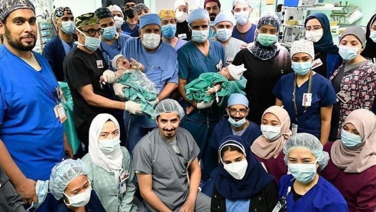 فريق طبي سعودي ينجح بفصل توأم سيامي يمني